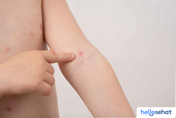 Lindungi Si Kecil: 5 Cara Ampuh Cegah Cacar Air