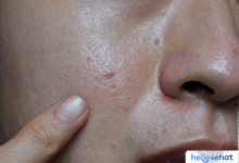 Rahasia Kulit Glowing? Atasi Sel Kulit Mati Sekarang!