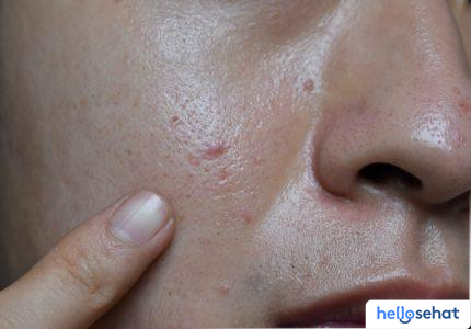 Rahasia Kulit Glowing? Atasi Sel Kulit Mati Sekarang!